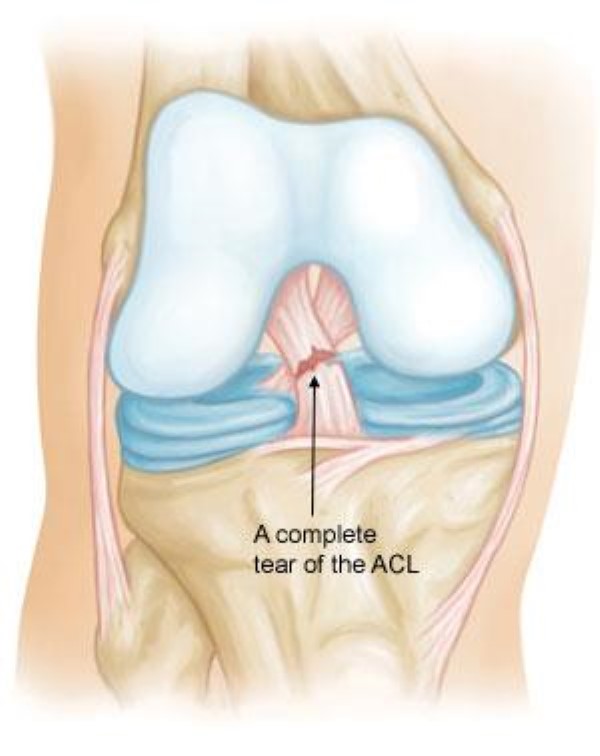 IMG_2224 Torn ACL