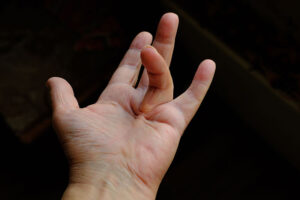 Dupuytren’s Contractures