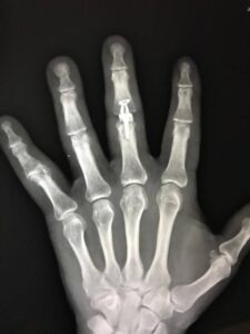 Joint Replacement Arthroplasty - Case 3