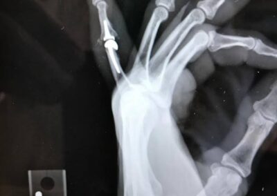 Joint Replacement Arthroplasty - Case 5