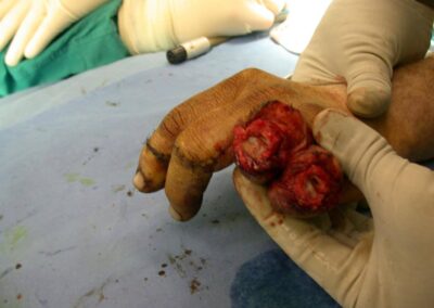 Joint Replacement Arthroplasty - Case 7