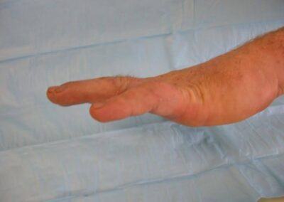 Joint Replacement Arthroplasty - Case 7