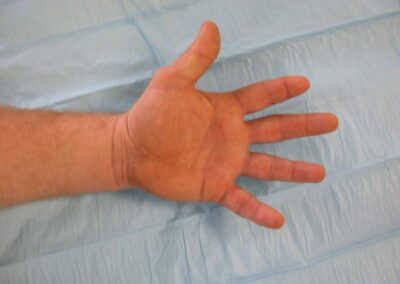 Joint Replacement Arthroplasty - Case 7