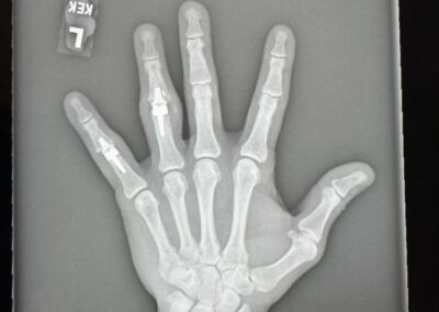 Joint Replacement Arthroplasty - Case 8