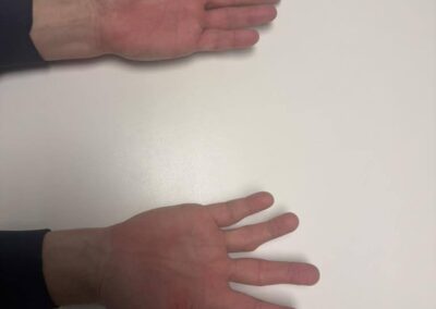 result of PIP joint cemented SR arthroplasty