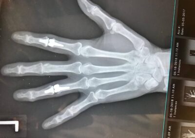 Finger Joint Arthritis and Joint Replacement Arthroplasty - Case 1