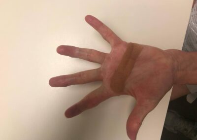 Finger Joint Arthritis and Joint Replacement Arthroplasty - Case 1