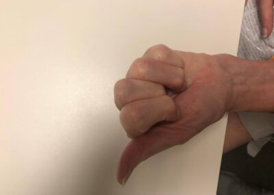 Finger Joint Arthritis and Joint Replacement Arthroplasty - Case 1